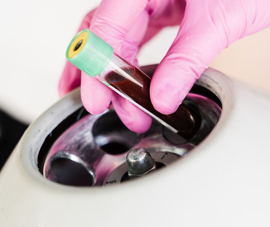 PRP Yüz Tedavisi (Vampir Facelift)