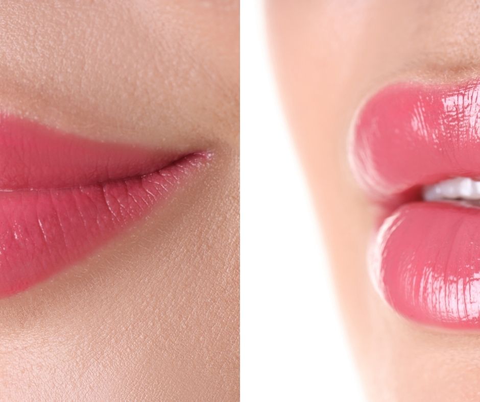 Dolgu Çeşitleri: Juvederm, Restylane, Teosyal Karşılaştırma