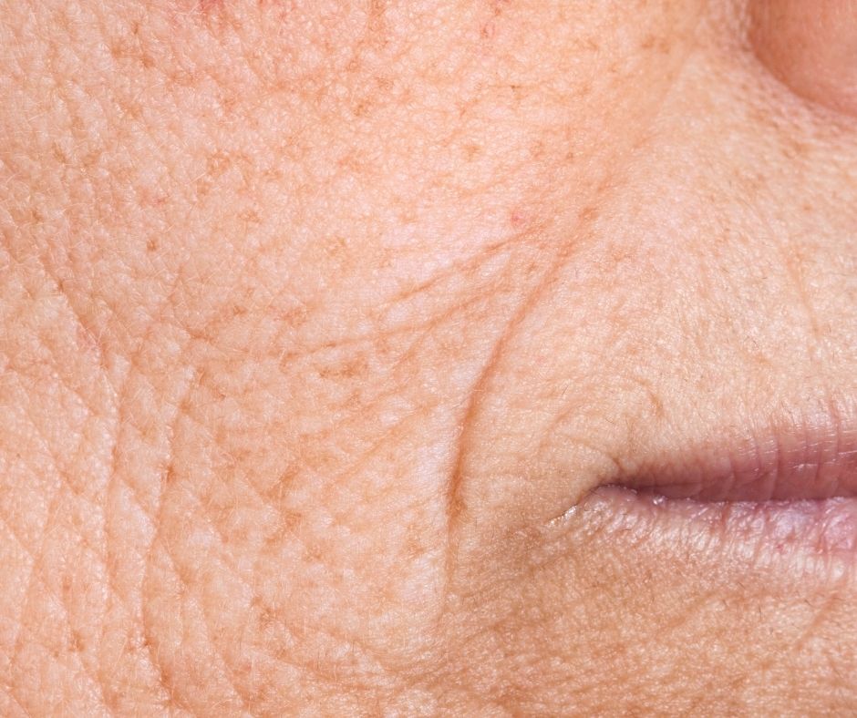 Dudak Kenarı Dolgusu: Sigara Çizgileri Tedavisi