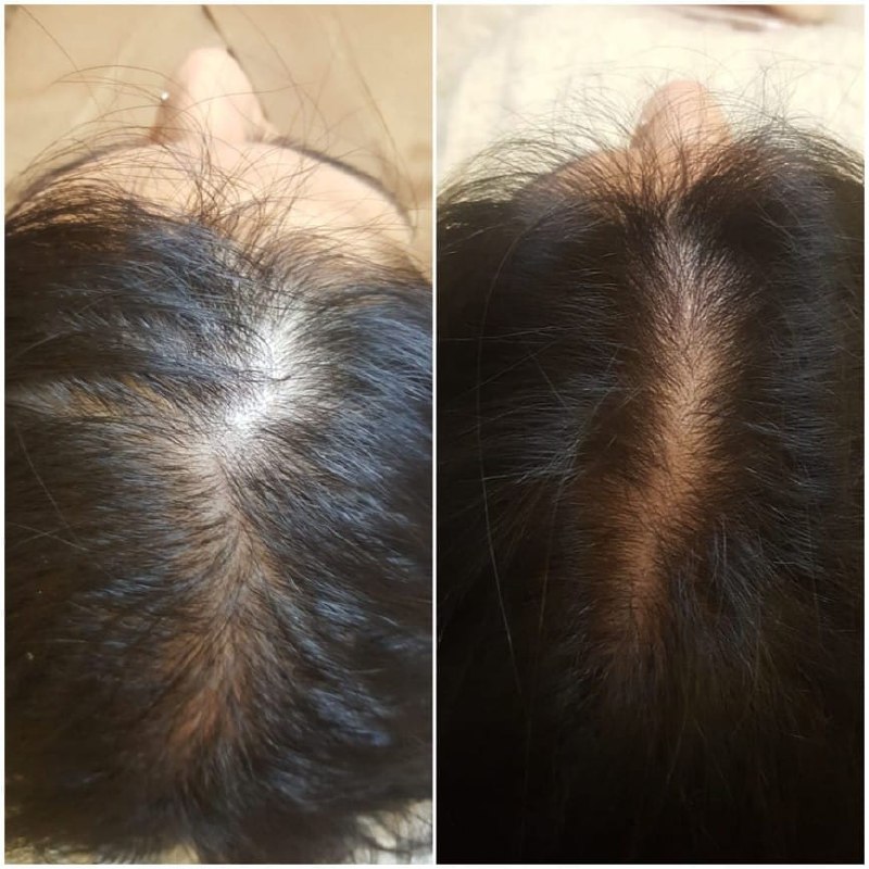 Saç mezoterapisi ve PRP uygulaması İstanbul - Dr. Hamza Gemici saç dökülmesi tedavisi öncesi sonrası